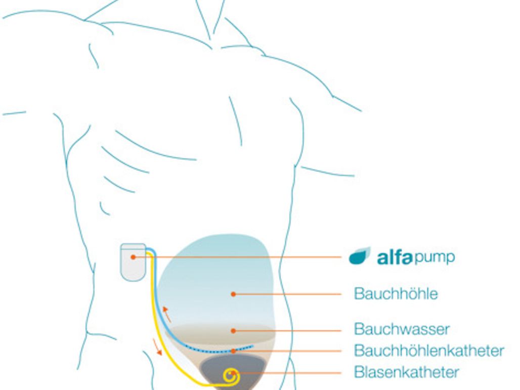 alfapump_funktion